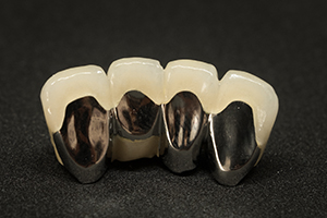 メタルボンドクラウン