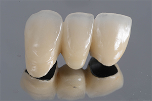 ハイブリッドレジンクラウン