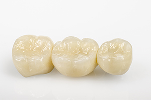 オールセラミッククラウン