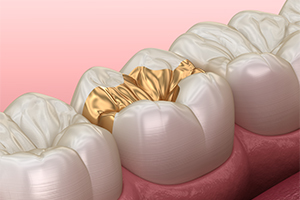 ゴールドインレー