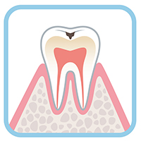 う蝕症第1度