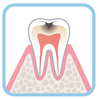 う蝕症第2度