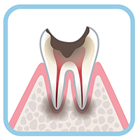う蝕症第4度