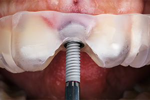 ガイドステント