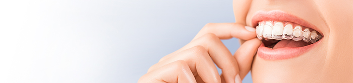 インビザライン