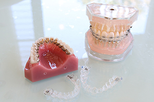 矯正のワイヤー　マウスピース